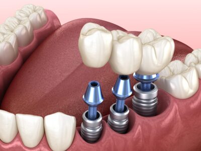 Что нужно знать о протезировании зубов?