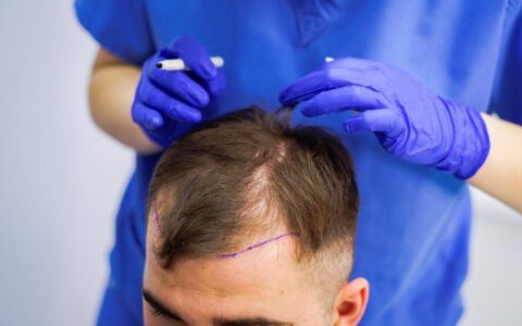 Современные методы трансплантации волос