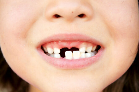 Особенности удаления молочных зубов у детей