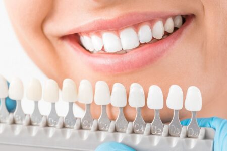 Как правильно выбрать виниры для зубов?