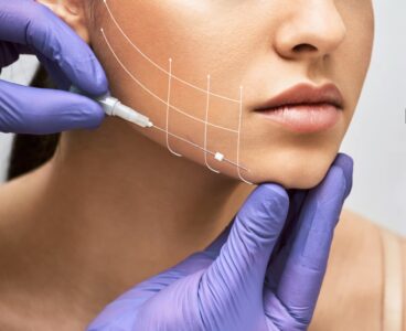 Нитевое армирование: действенный метод по малотравматичной подтяжке кожных покровов лица и тела