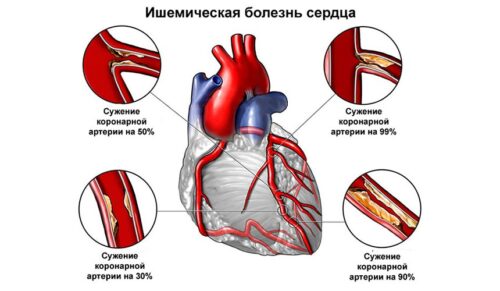 С чего начать лечение ишемической болезни сердца?