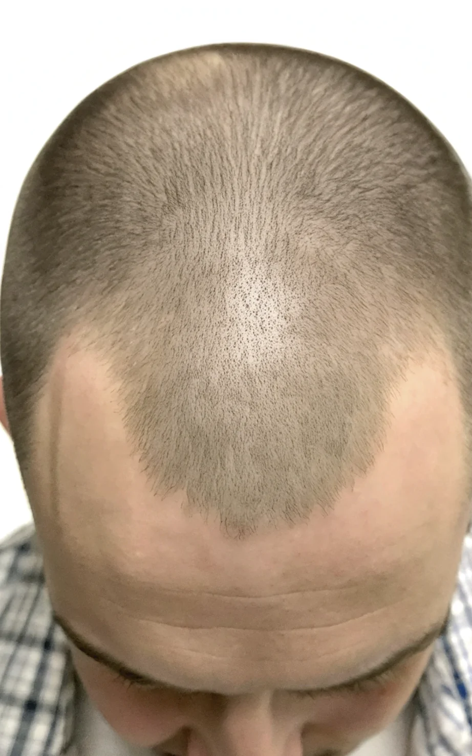 Как вернуть густоту: пересадка волос для мужчин ручным методом FUE Hand без лишней шумихи