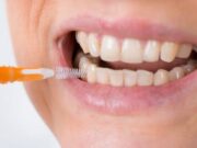 Уход за полостью рта после протезирования зубов на имплантах