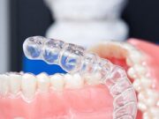 Что такое элайнеры и для чего они нужны?