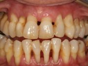 Революционные методы лечения пародонтоза в Германии