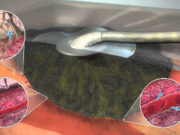 Вакуумная терапия: высокоэффективный метод лечения ран