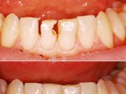 Методы восстановления зубов