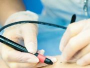 Что представляет собой салонная электроэпиляция?