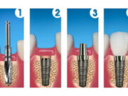 Этапы имплантации зубов