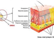 HIFU SMAS: единственный метод воздействия на нижележащий мышечно-апоневротический слой, а не на кожу