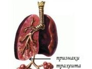 Симптомы трахеита