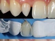 Реставрация зубов :эстетическое восстановление зубного ряда