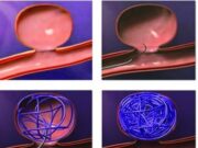 Методы лечения эмболии