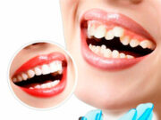 Капа для зубов надежная защита и эффективное лечение