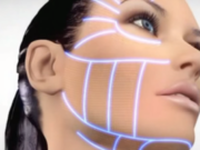 Что представляет собой СМАС лифтинг?