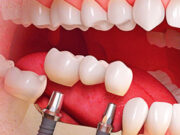 Современные методы протезирования зубов