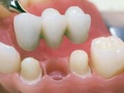 Мостовидные протезы: виды, преимущества, недостатки