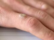 Причины появления бородавок