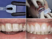 Пошаговая технология установки виниров