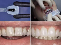 Пошаговая технология установки виниров