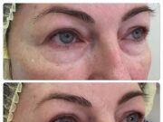 Mesoeye С71: инъекционный препарат для век и зоны вокруг глаз