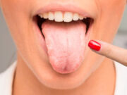 Кандидоз: симптомы и схема лечения