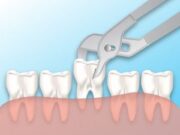 Что нужно знать при удалении зуба?