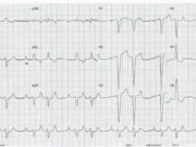 Что представляет собой ЭКГ здорового человека?