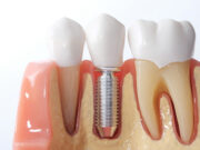 Преимущества имплантации зубов