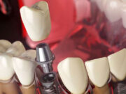 Какие существуют виды зубных имплантов?