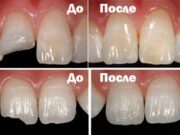 Реставрация зубов с помощью наращивания