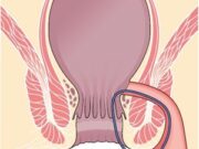 Парапроктит: одно из тех заболеваний, которое не поддается лечению в домашних условиях