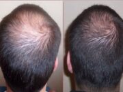 Миноксидил: принцип действия и эффективность