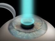 Лазерная коррекция: эффективный способ восстановления зрения