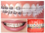 Виды брекетов