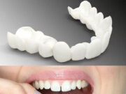 Какие виниры для зубов лучше?