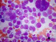 Как выявить гемобластоз?