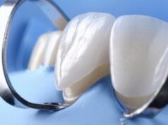 Установка виниров E-MAX