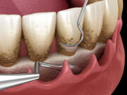 Закрытый кюретаж: техника проведения