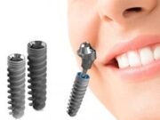 Особенности метода экспресс-имплантации зубов