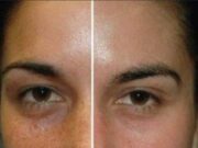 Особенности гликолевого пилинга