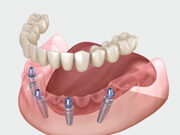 Протезирование зубов за один день