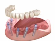 Имплантаты OneQ-SL при немедленной имплантации
