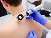 Современные методы лечения меланомы