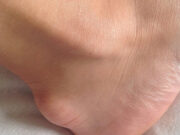 Бурсит пятки: причины возникновения