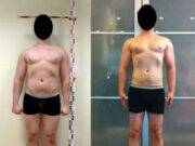 Тонкости операции по увеличению роста