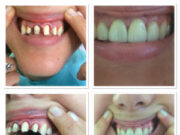 Правильная подготовка к протезированию зубов