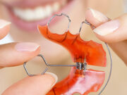 Выбор системы вестибулярных брекетов