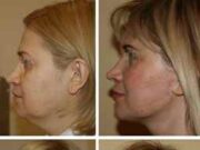 СМАС лифтинг: современная эффективная косметологическая процедура, которая позволяет омолодить кожу и улучшить овал лица